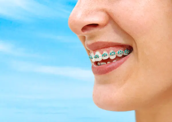 How To Get The Best Outcome When Wearing Braces