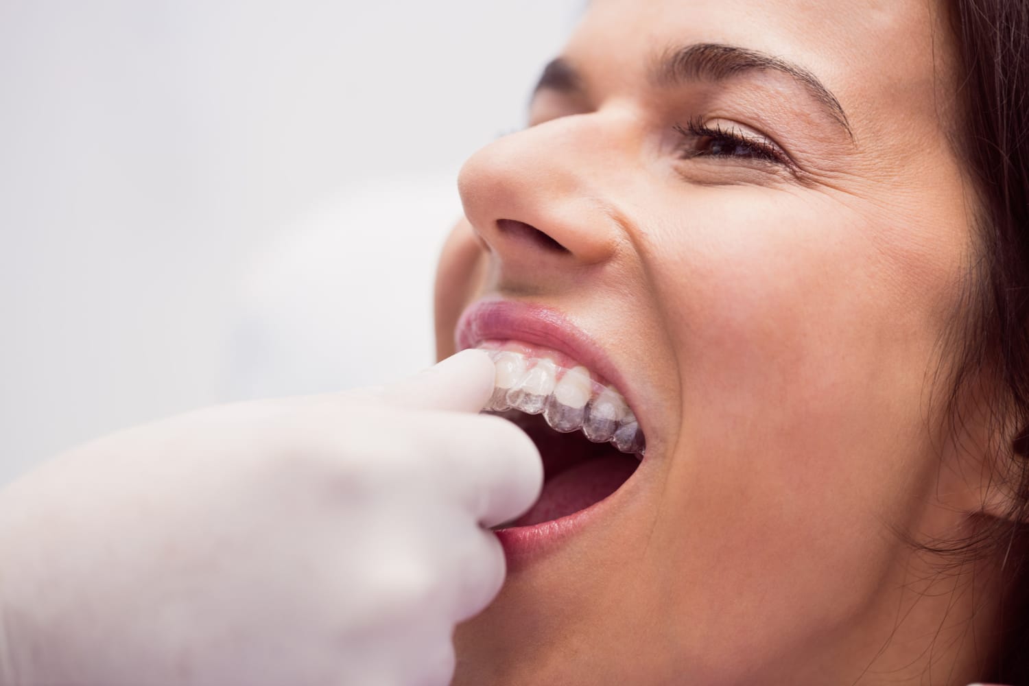Invisalign Cost Palo Alto