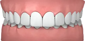 Upper Front Teeth Protrusion