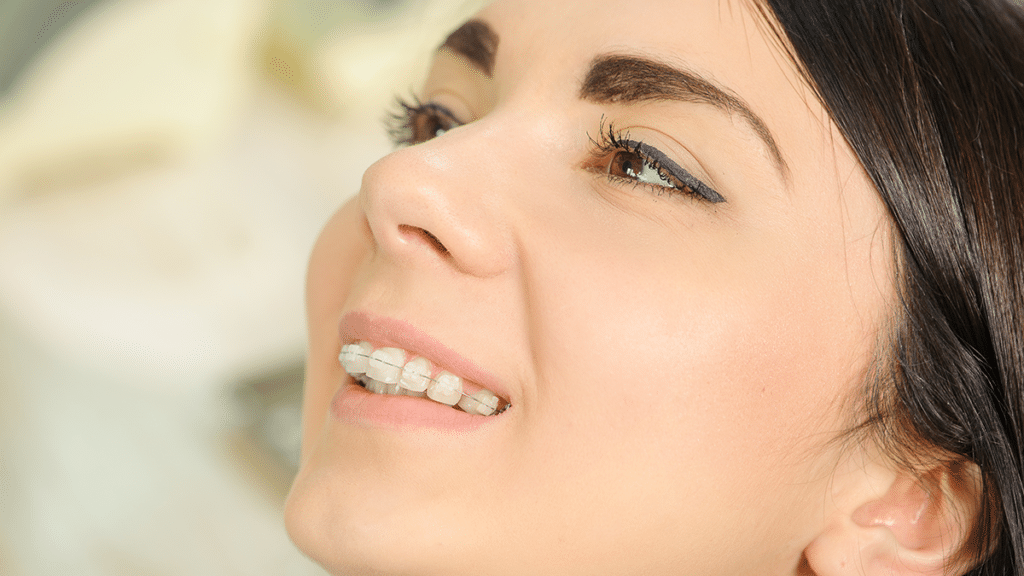 Clear Braces For Adults Feel Confident And Get Your Dream Smile