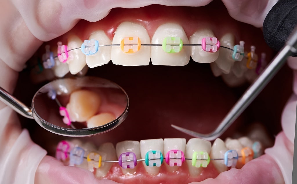 Difference Between A Dentist And An Orthodontist In Palo Alto