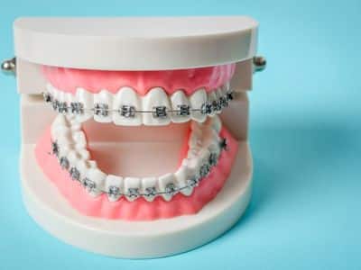 Braces While Pregnant