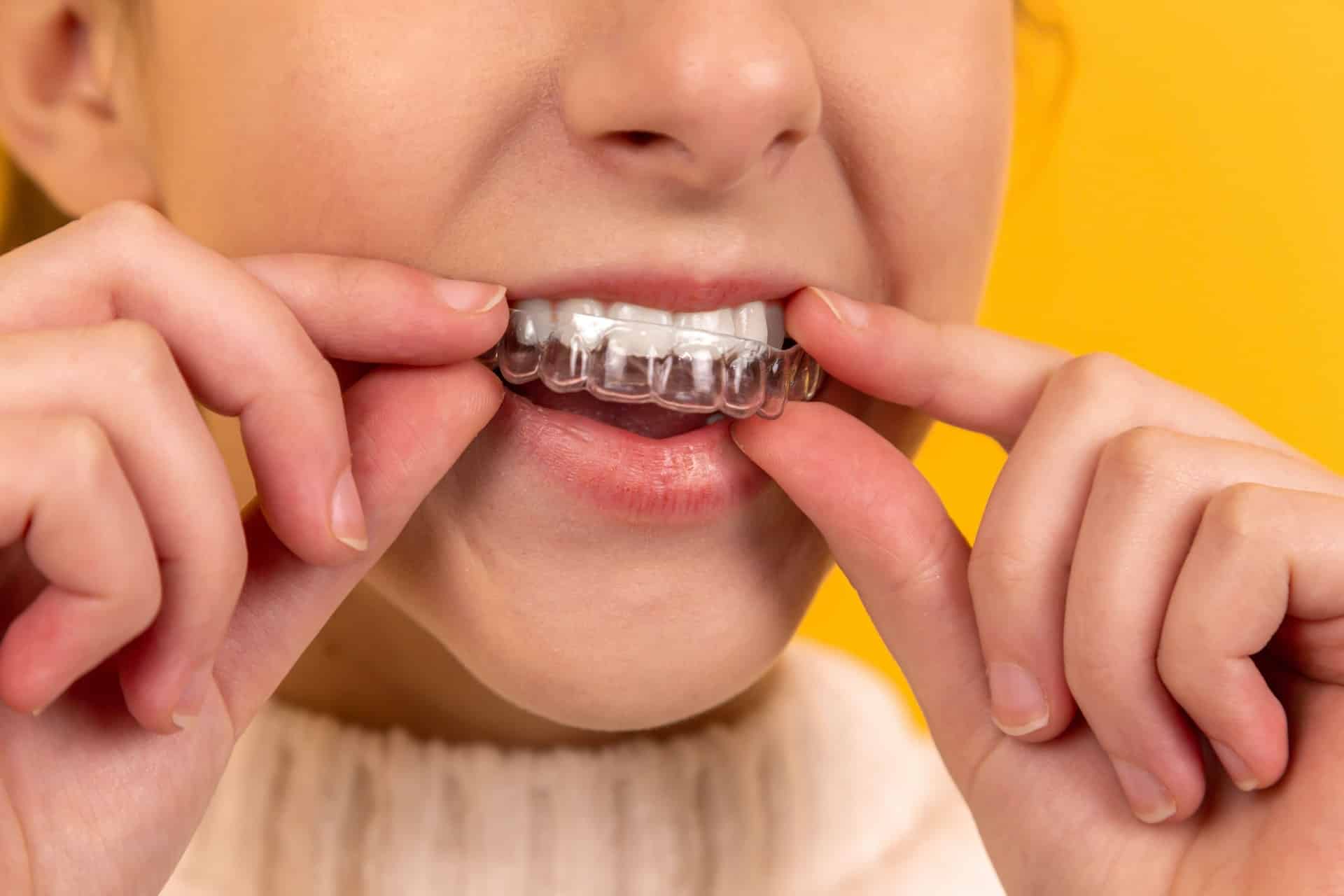 Invisalign Overbite