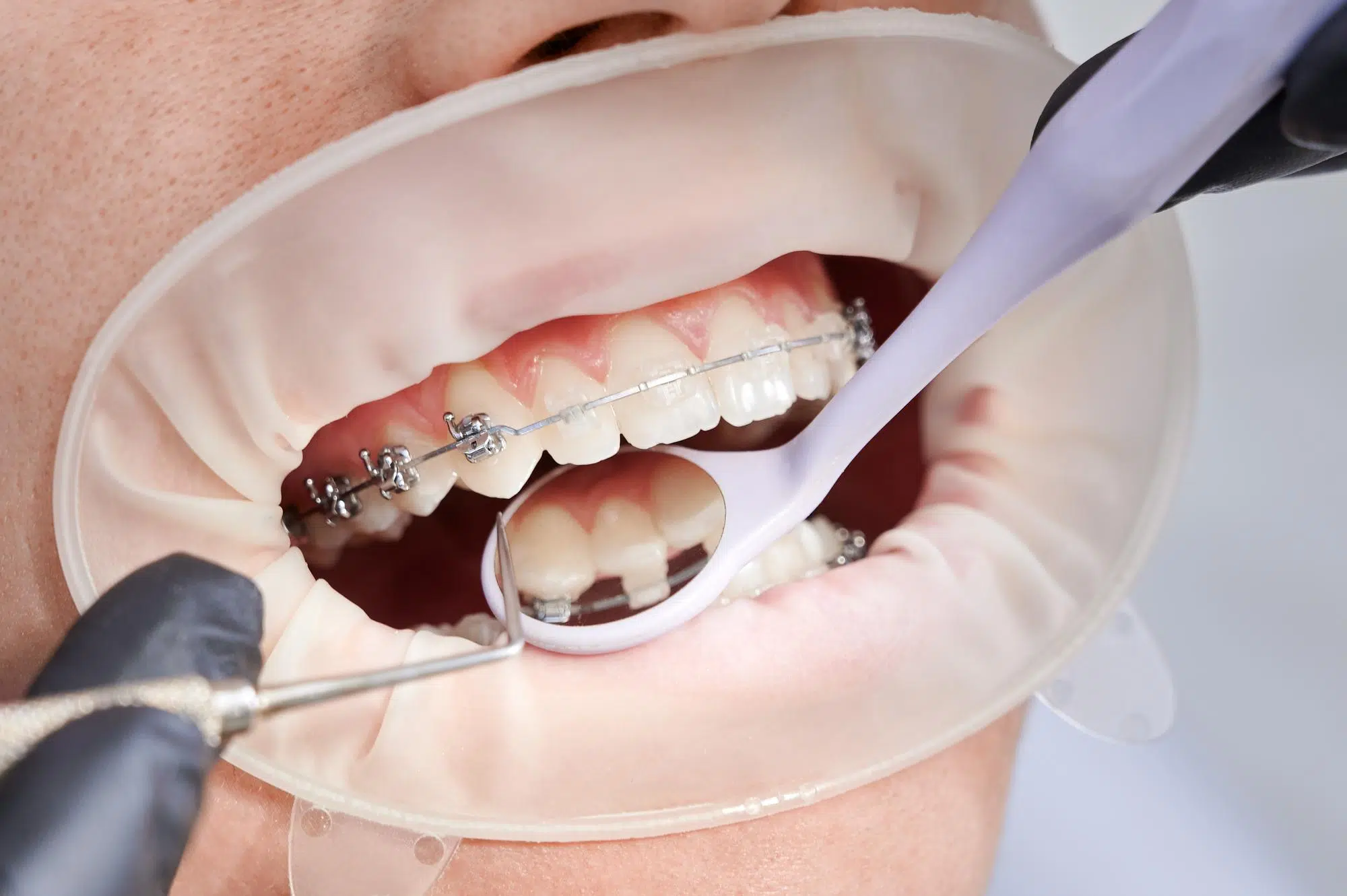 Pros And Cons Of Ceramic Braces In Atherton: Straight Facts