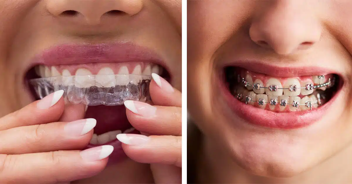 Invisalign vs Traditional Braces: Ideal Solution for Adults
