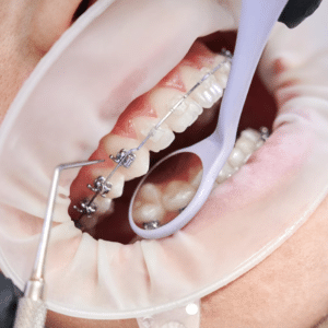 Orthodontic Emergencies: A Guide for Unexpected Situations
