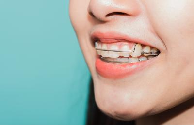 Retainers After Braces: Keeping Your New Smile the Right Way