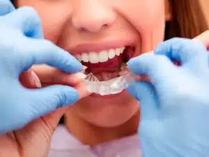 Invisalign Treatment Tips