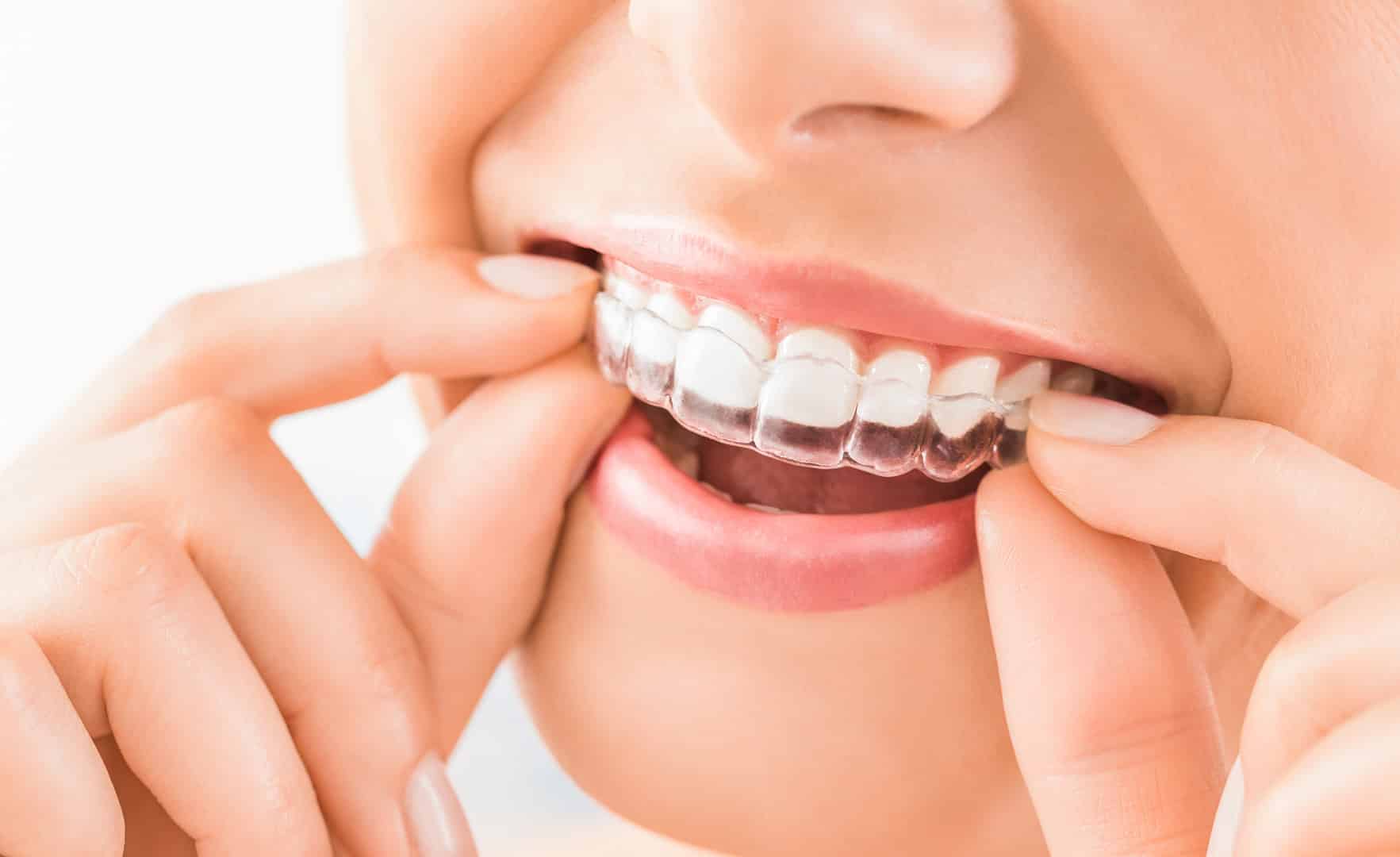 Caring For Your Invisalign Aligners