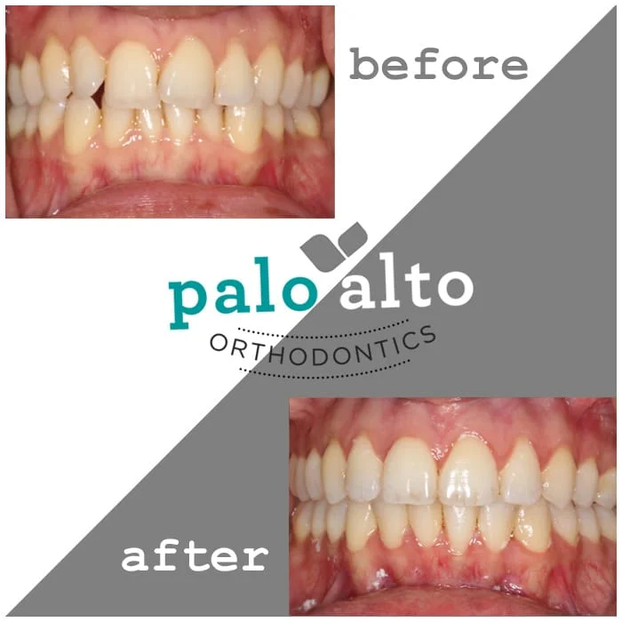 Crowding Treated with Invisalign