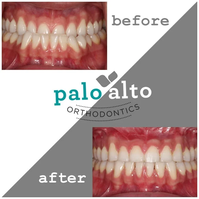 Underbite Treated with Braces