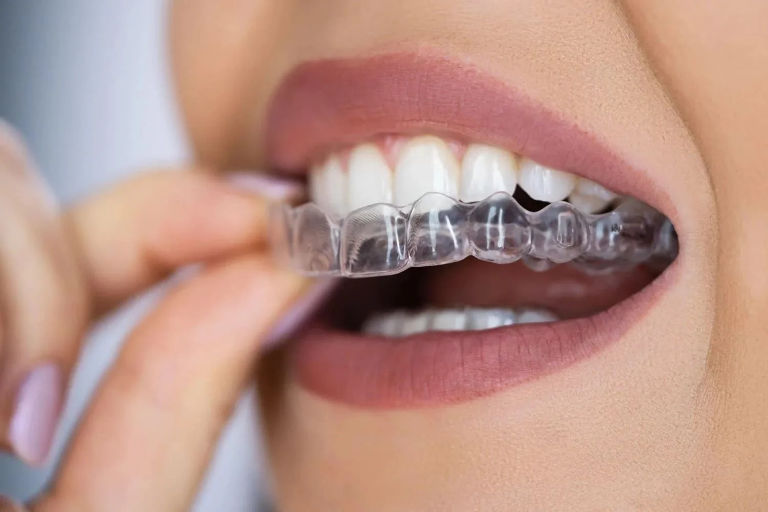 How Fast Does Invisalign Work
