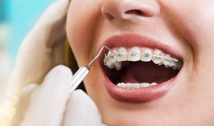 Braces Before Jaw Surgery With An Orthodontist Treating A Woman