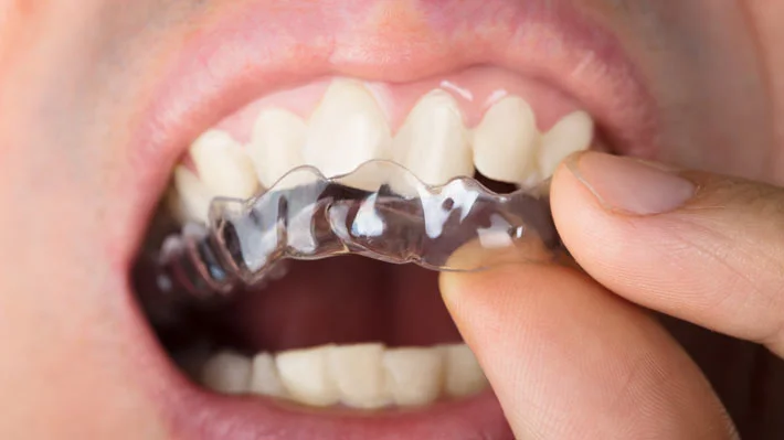 Adjusting Invisalign For Crowded Teeth