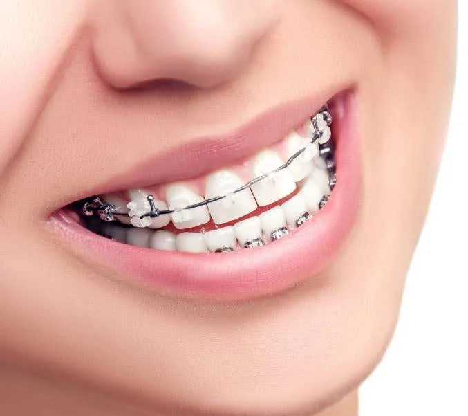 Types Of Mouth Braces Options For Women